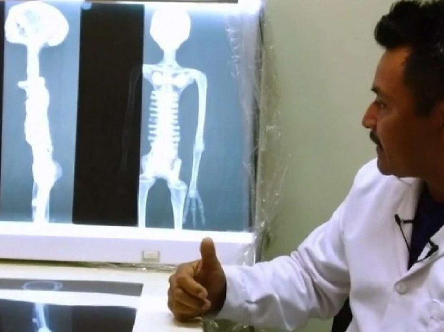 Nazca mumiyasının bədənindən müəmmalı implant çıxarıldı 