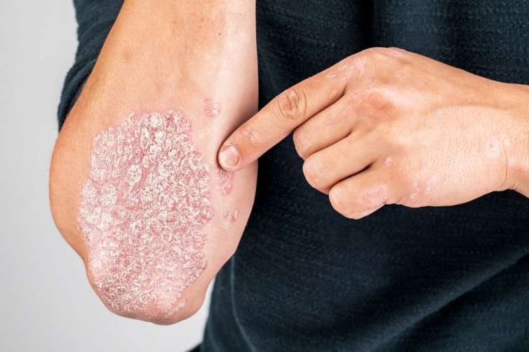 Alimlər psoriazın potensial səbəbini tapdılar 